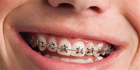 wild style metal brackets braces|Wildsmiles Braces .